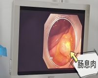 肠息肉有几种?