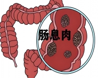 长了肠息肉会有哪些表现?