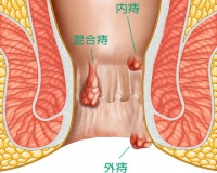 痔疮，是一种怎样的存在?