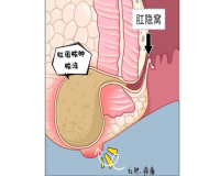 肛周脓肿的发展过程是什么?