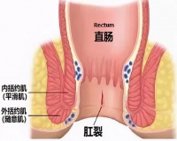 肛裂应该怎么治?