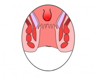 内痔呢?长什么样?