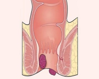 引起混合痔的原因？
