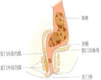 大便干燥，你有这些症状吗?