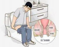 男性得痔疮具体的原因是什么?