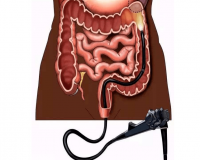 为什么40岁以后需做一次肠镜检查?
