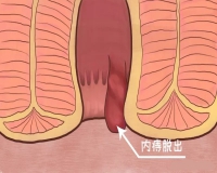 内痔的典型症状?