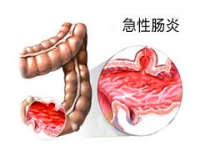 急性肠炎可以不治疗吗?