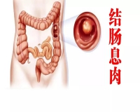 结肠广基息肉的诊断与治疗?