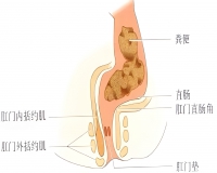 便便卡在肛门口拉不出来的救急方法?