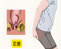 肛瘘是不是必须做手术?