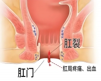 肛裂怎么治好得快?