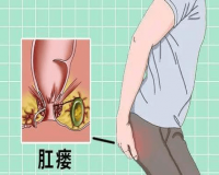 肛瘘是什么症状表现?