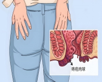 为什么会得痔疮?