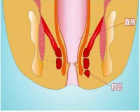 肛瘘的主要症状是什么呢？