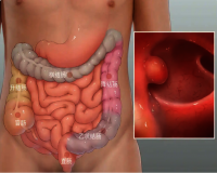 肠息肉切除后,到底多久复查一次?