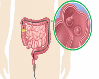 肠息肉切除后，选择复查时间?
