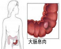 直肠息肉一定要切吗?