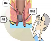 进入三伏天，痔疮发作如何应对?