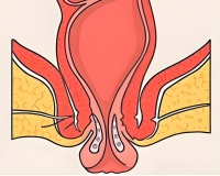 直肠脱垂严重吗?