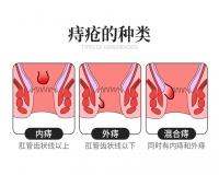 不同类型痔疮的症状有什么?