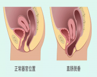 脱肛怎么处理?