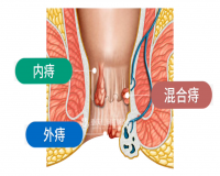 痔疮发生部位如何界定的?