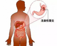 什么是浅表性胃炎？浅表性胃炎的症状有哪些？