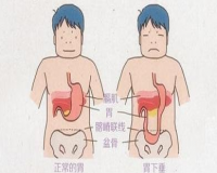 什么是胃下垂？哪些人容易患胃下垂？