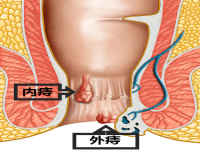 内痔外痔混合痔的区别?