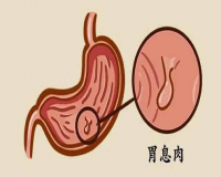 什么是胃息肉？胃息肉的分类