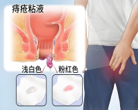 痔疮有哪些症状?