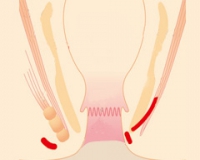 肛裂手术后会复发吗?