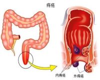 有痔疮是一种什么存在?