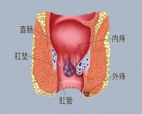 痔疮手术后注意事项?