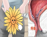 得了痔疮的生活方式?