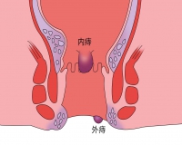 肛门处突然肿大什么原因?