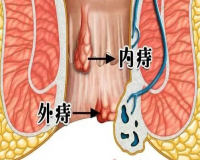 痔疮的成因多种多样?