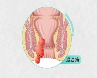 痔疮出血,不能小视!