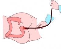 肠镜价格一般多少钱?