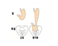 怎样避免胃下垂？