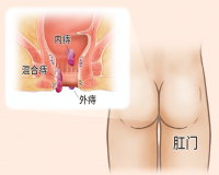 痔疮不治疗会怎么样?
