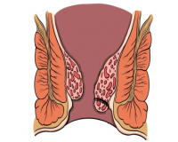 什么是肛周脓肿?