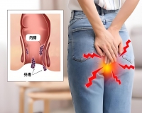 痔疮有哪些表现?