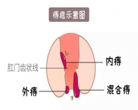 关于痔疮的画像?