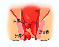 痔疮出血怎么治疗法?