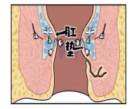 肛瘘的症状有哪些?