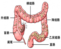 患上了结肠息肉