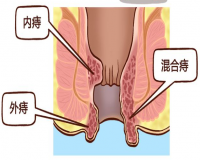 正确区分内痔?