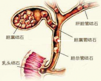 哪些人容易患胆囊结石？